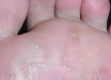 脚底长了像水泡一样的东西很痒是什么原因（脚底长了像水泡一样的东西很痒是什么原因）