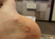脚上起小水泡还很痒？别忽视，这几种常见原因在作怪