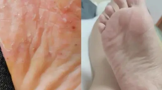 脚底长了像水泡一样的东西很痒是什么原因(脚底长了像水泡一样的东西很痒是什么原因) 脚底长了像水泡一样的东西很痒是什么原因(脚底长了像水泡一样的东西很痒是什么原因)