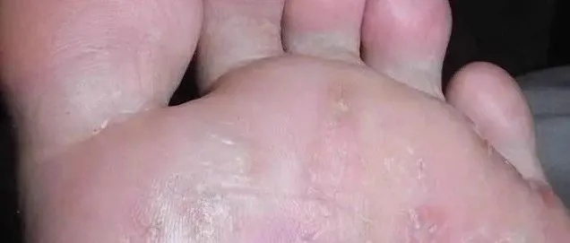 脚底长了像水泡一样的东西很痒是什么原因(脚底长了像水泡一样的东西很痒是什么原因) 脚底长了像水泡一样的东西很痒是什么原因(脚底长了像水泡一样的东西很痒是什么原因)